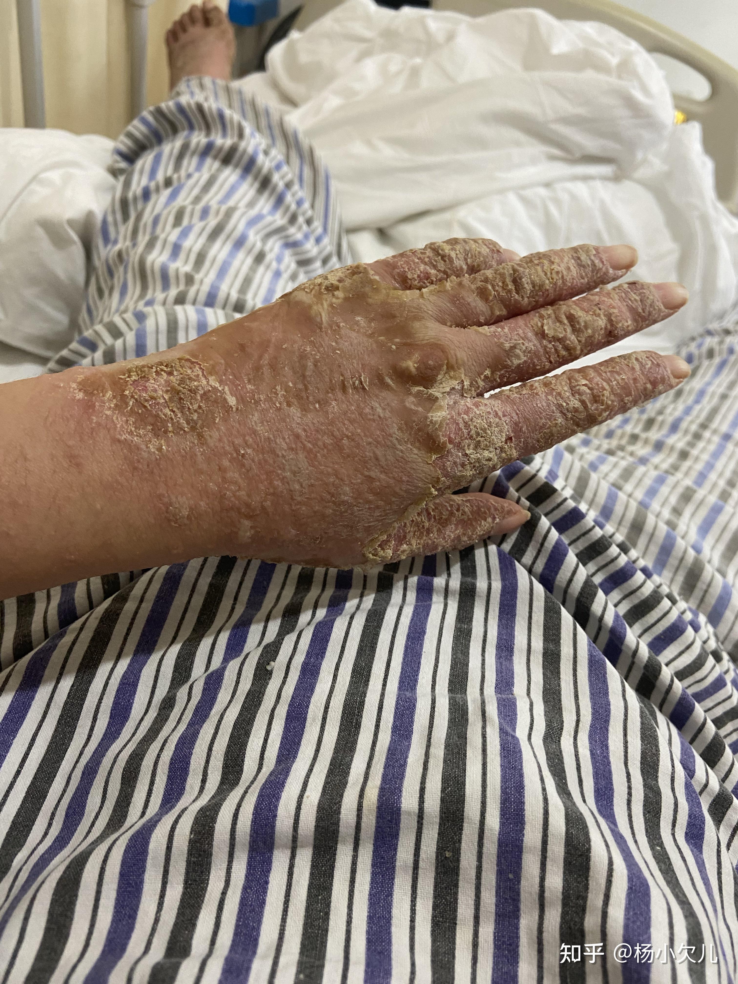 生物制剂治疗强直引发银屑病