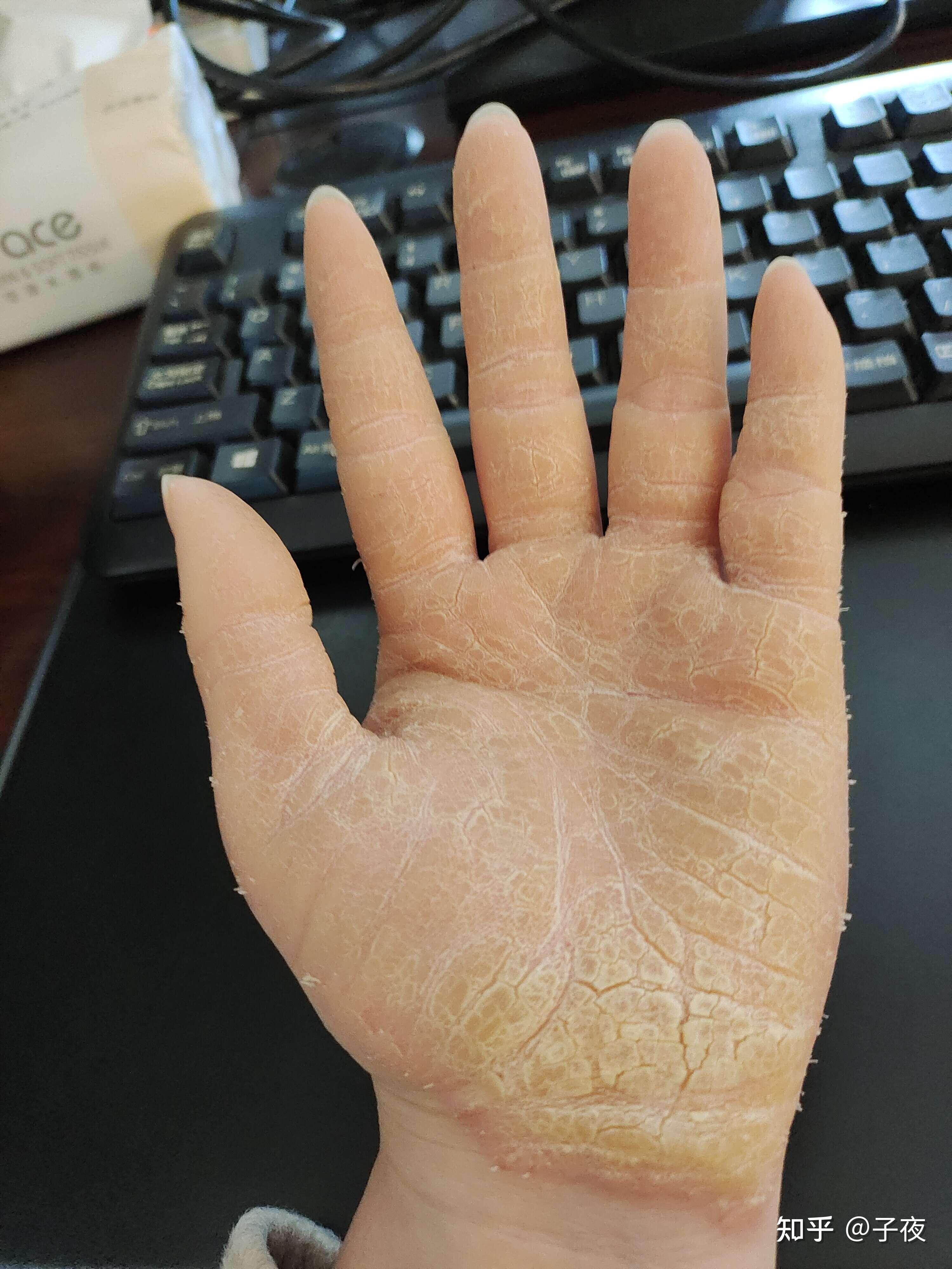 请问有没有人得了掌趾角化症的患者?