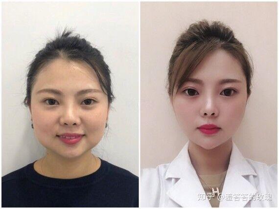 打完溶脂针恢复过程是一种什么体验? - 知乎