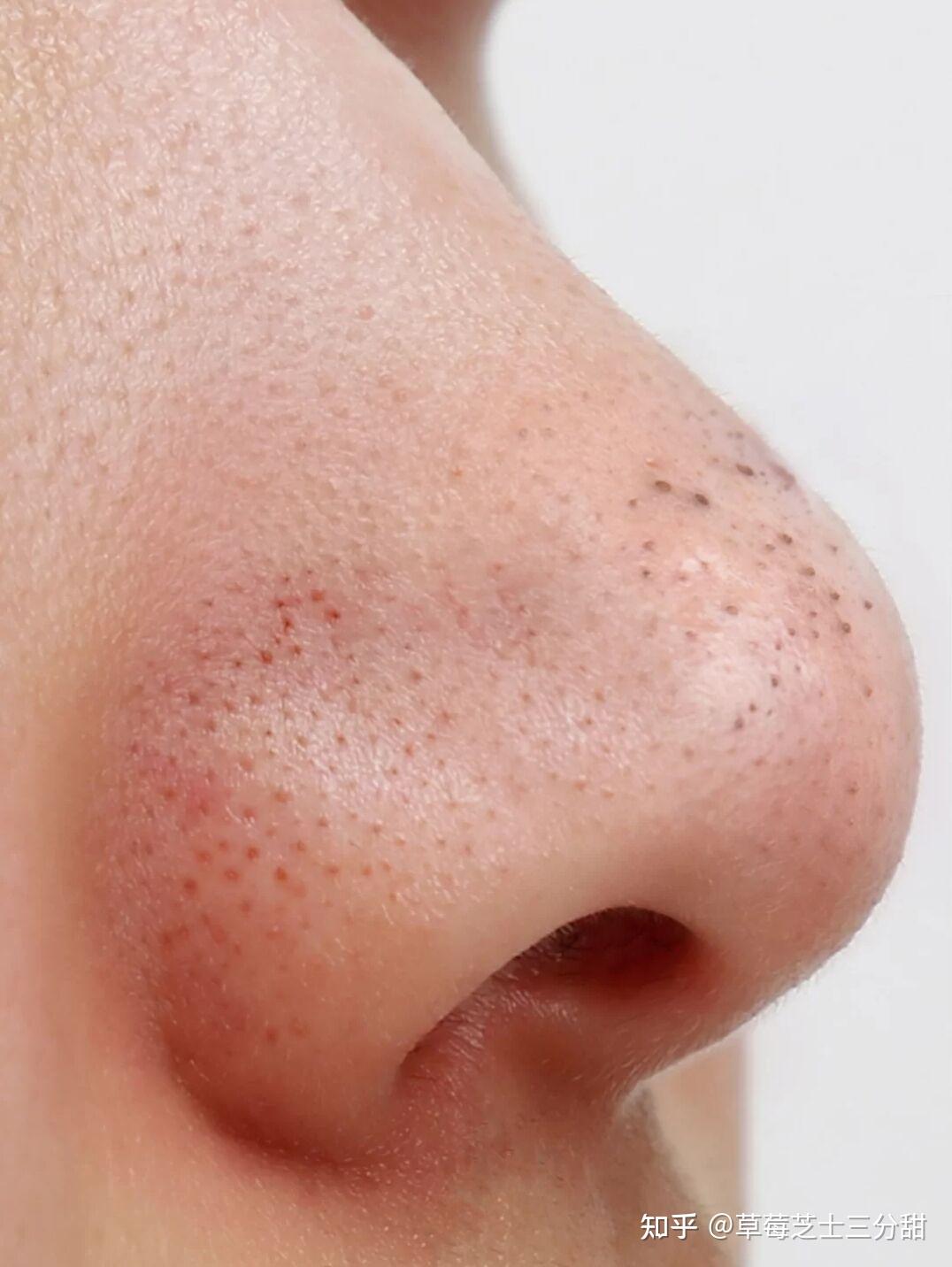最近很火的李佳琦去黑头办法—乳糖酸真的能解决黑头吗?需要用多久才能起效果? - 知乎