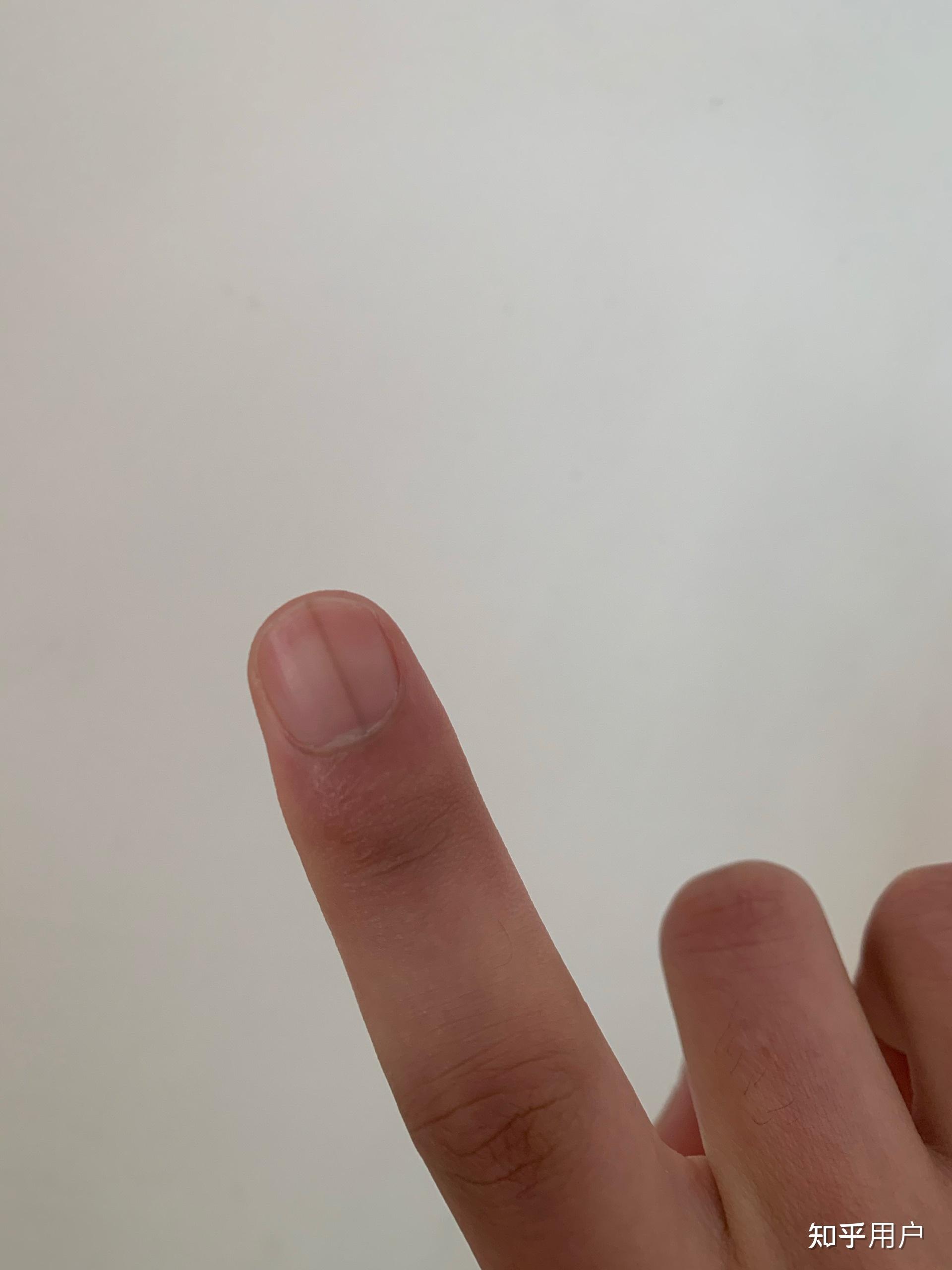 左手大拇指指甲有一条淡褐色竖线,好几年了,微量元素也正常,为什么啊?