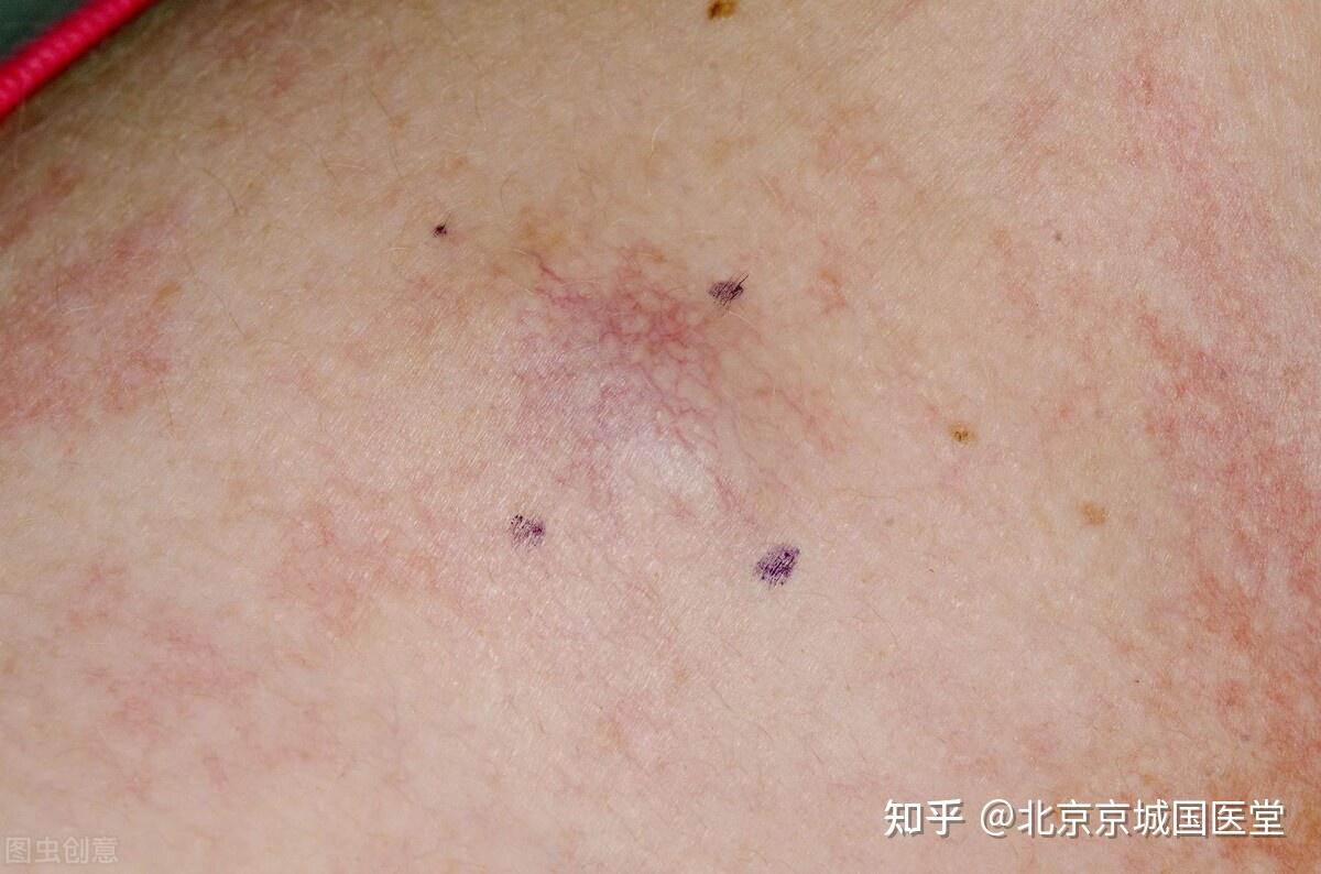 皮肤癌早期的三个典型症状_刘文斌医生视频讲解皮肤科疾病-快速问医生