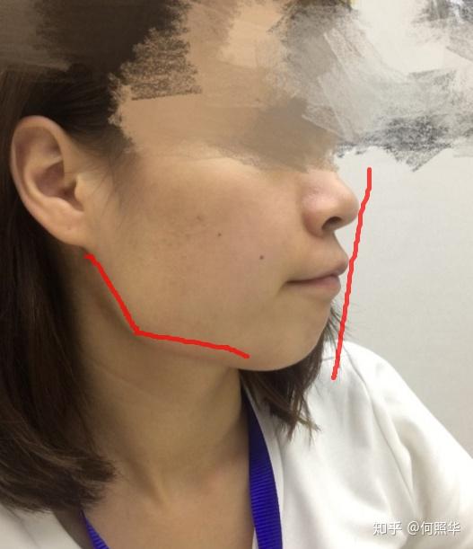 我这下颌角和咬肌都大这方脸还有没有的救了啊该怎么办有图
