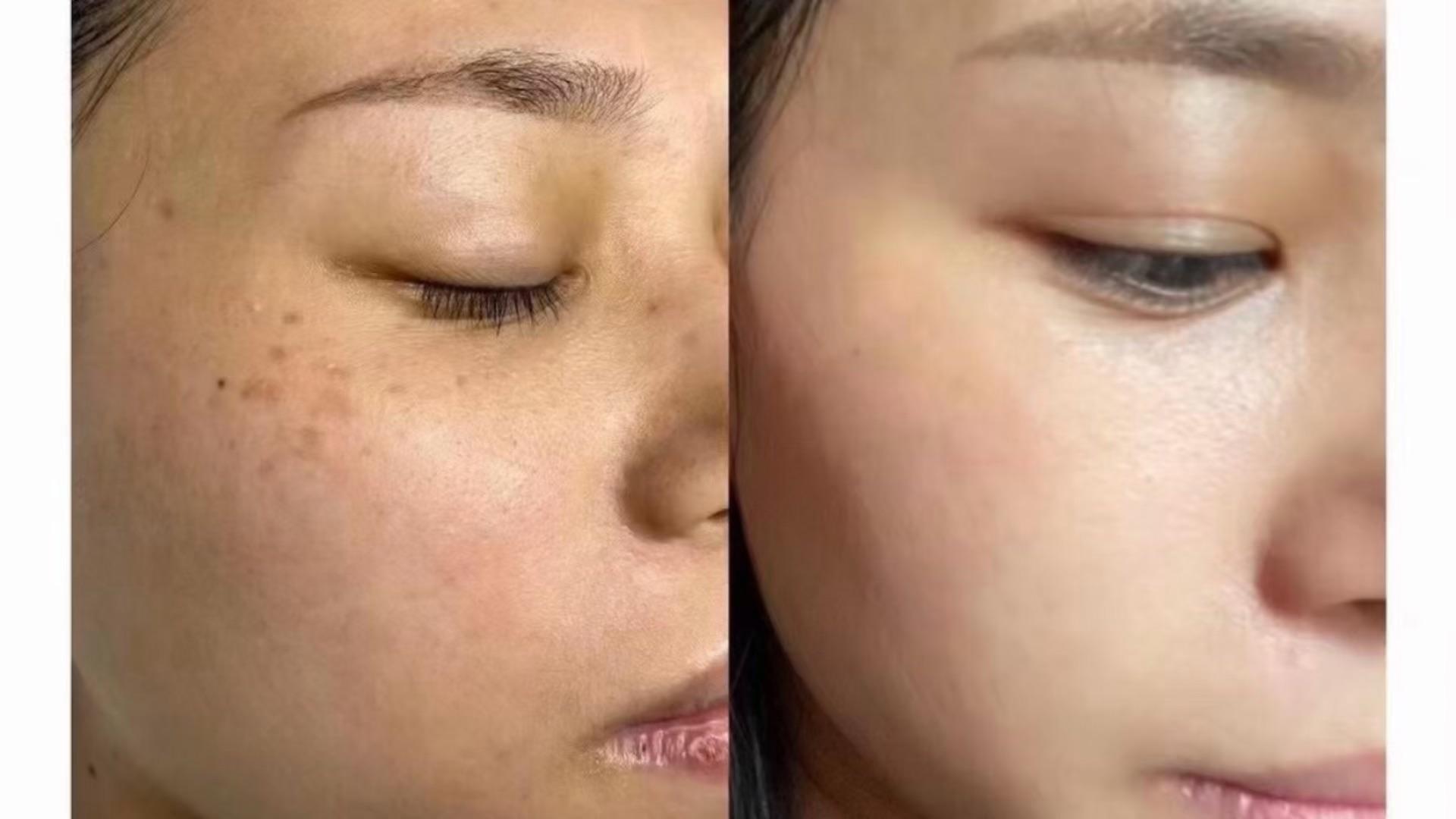 色素斑应该怎样治疗? - 知乎