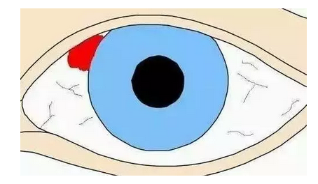 眼白一片鲜红就是眼底出血吗 90 的人都误解了 知乎