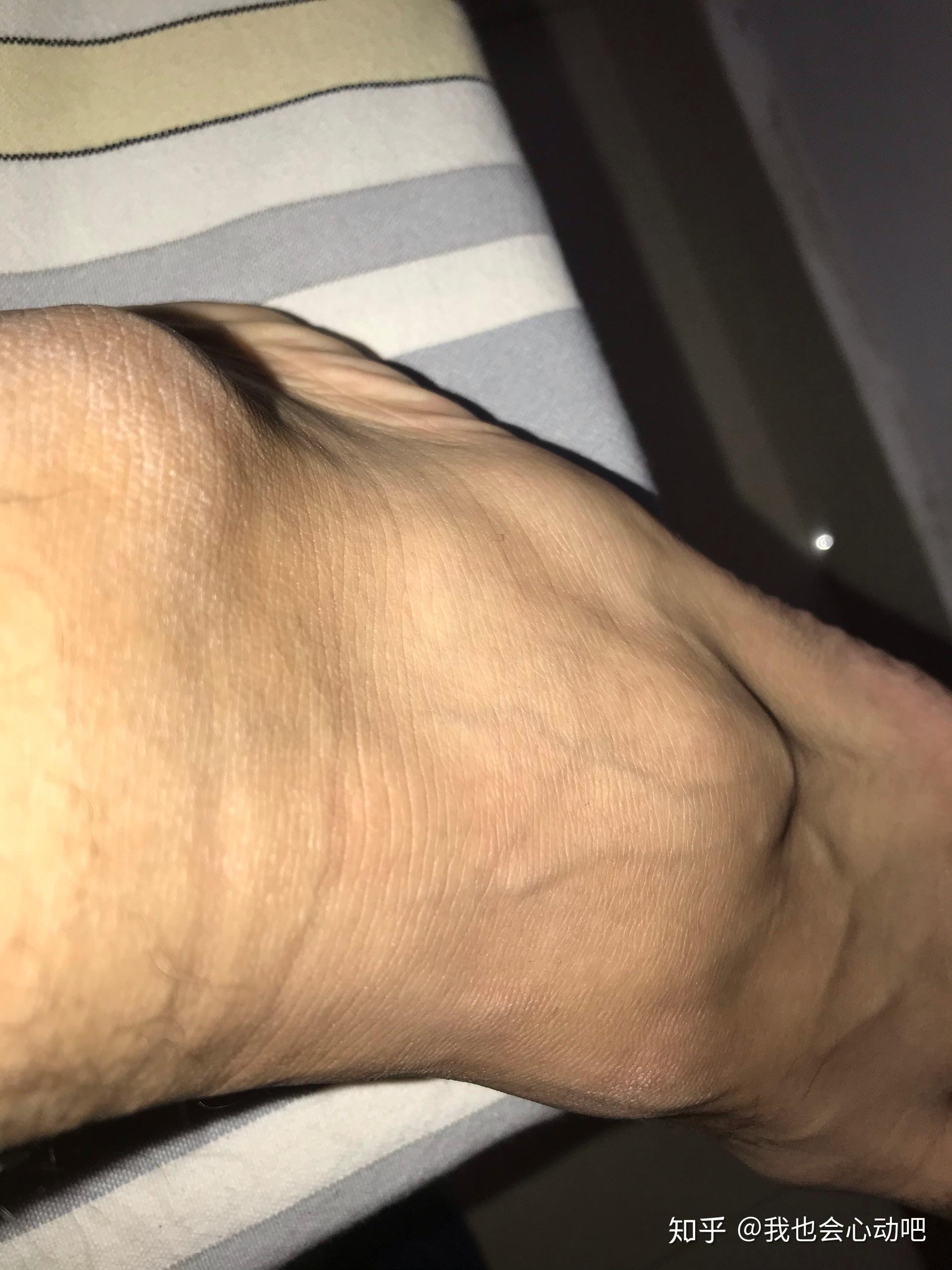 左脚第五跖骨基底部骨折需要几个月恢复?
