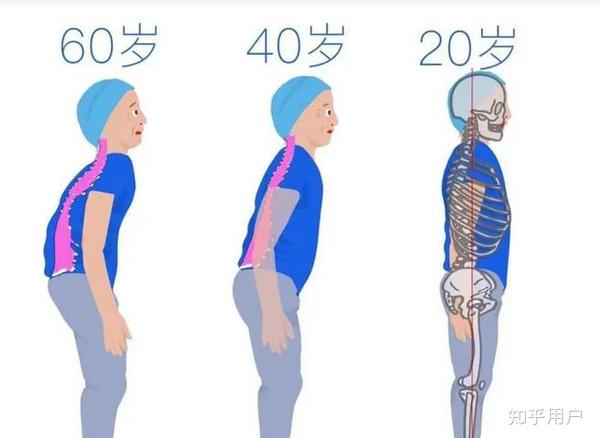 走路弯腰驼背怎么办?平时不管什么时候都要挺直腰板 - 知乎
