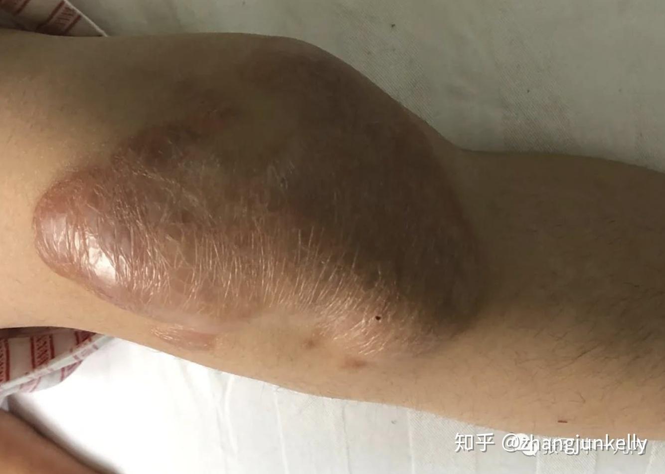 男孩子的隐私部位(小睾丸);皮肤黄色瘤--需要关注 - 知乎