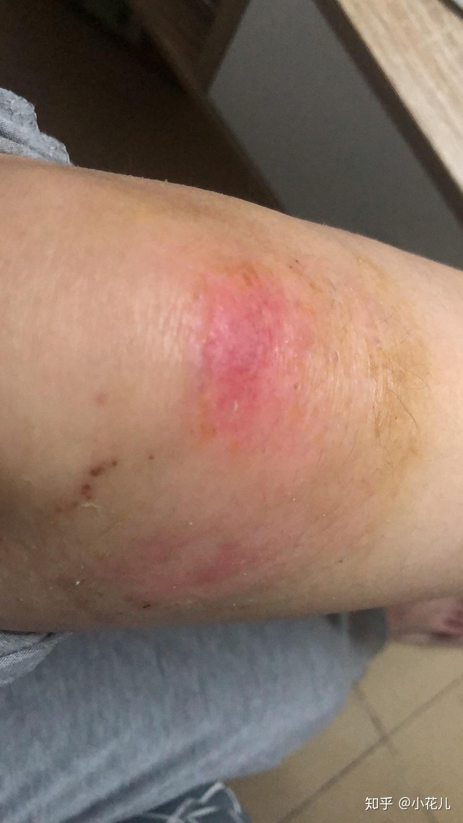 双膝擦伤恢复去疤纪录贴