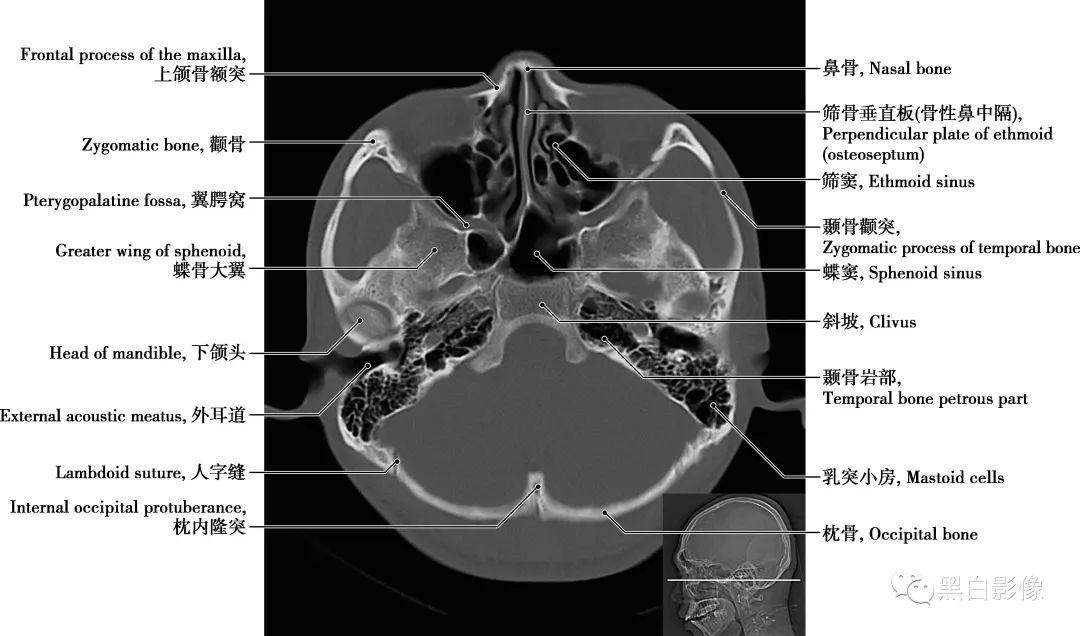 颅骨解剖图ct图片