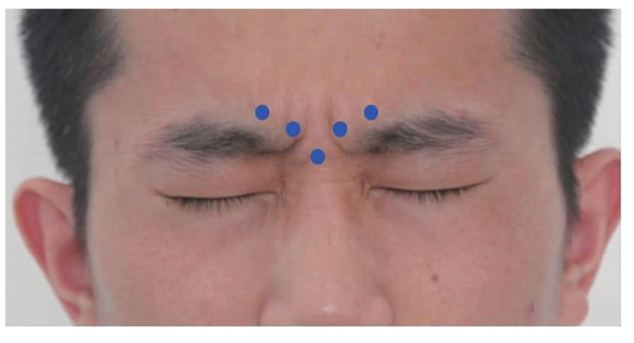 图 1-4 皱眉肌及降眉间肌体表注射位点注意事项:1.
