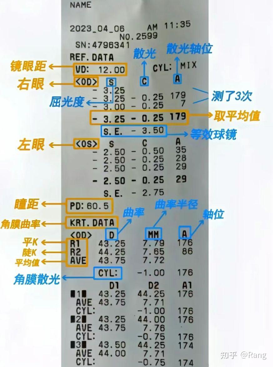 如果眼压过高会导致青光眼,症状:看事物时视野缺陷或视力下降角膜厚度