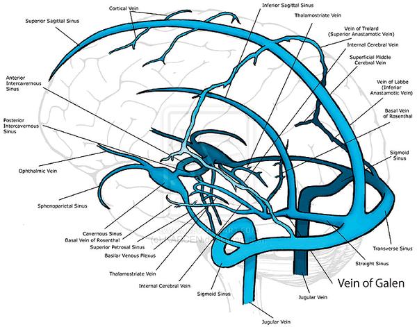 什么是vogm大脑大静脉畸形