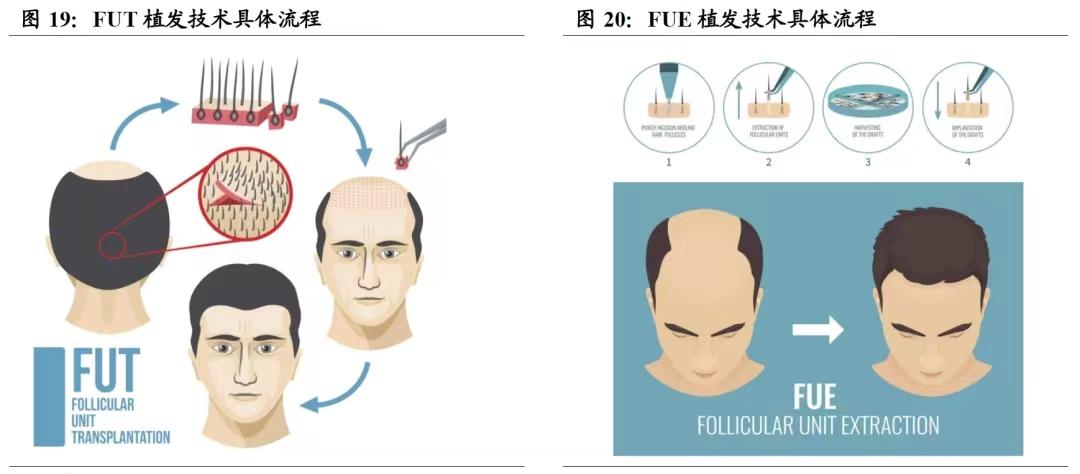 植发机构的:fue,fut,微针,不剃发植发这些植发专利技术哪个好?