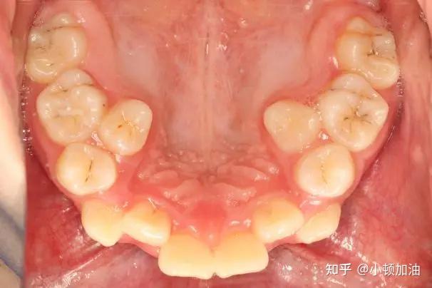 出来代替乳牙的恒牙,如果恒牙胚的发育受到影响,可能会造成恒牙的形态