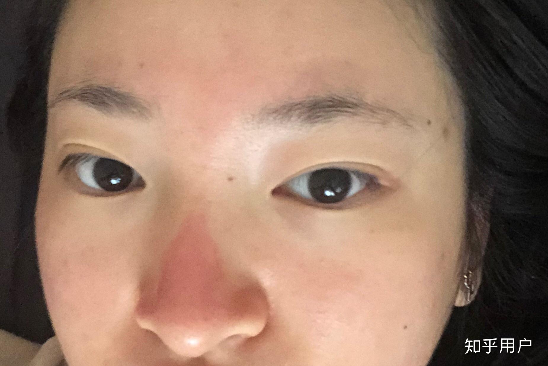 脸晒伤啥样? - 知乎