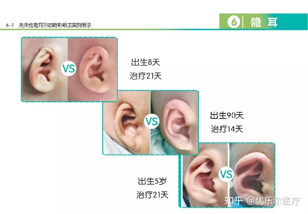 宝宝耳轮往内折图片