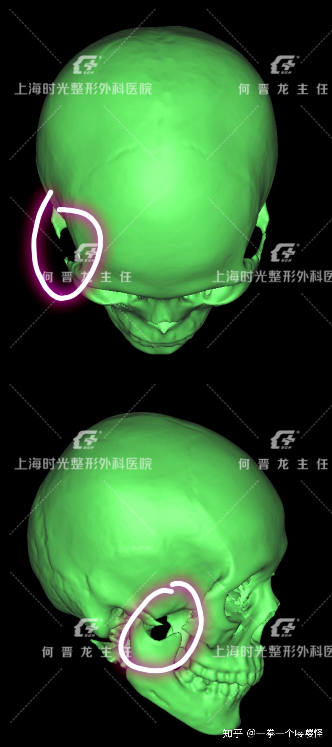 个性化3D定制重建颧骨颧弓手术临床案例分析 - 知乎