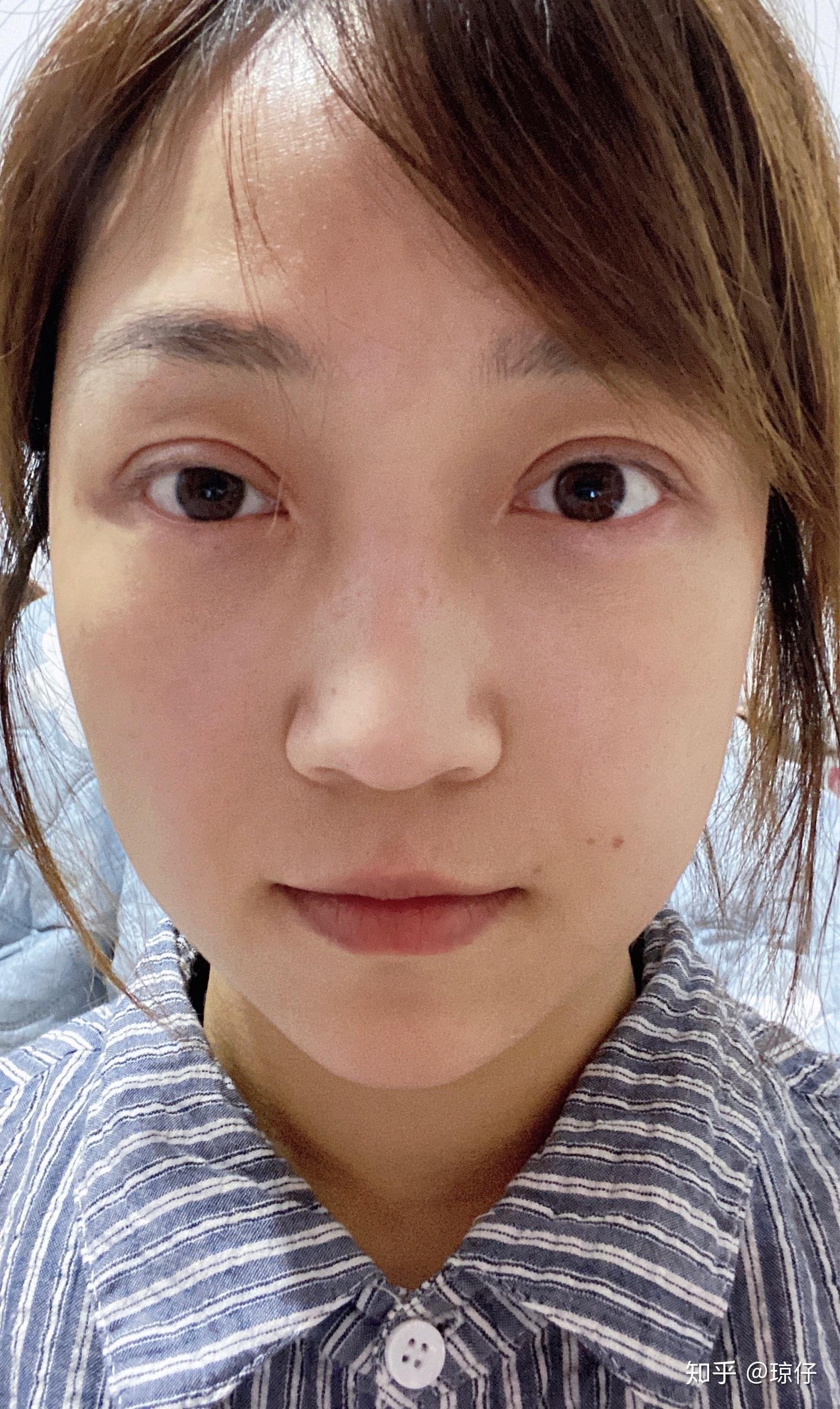 双眼皮三个月 - 知乎