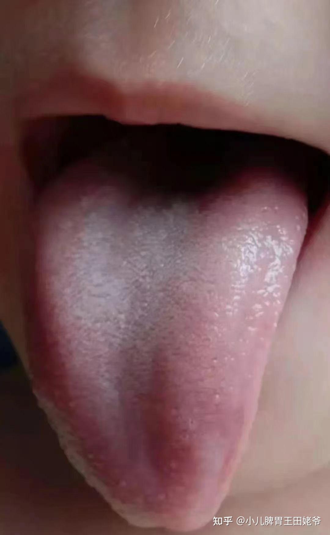 脾胃虚弱舌苔症状图图片