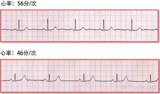 心电图怎么算心率图片