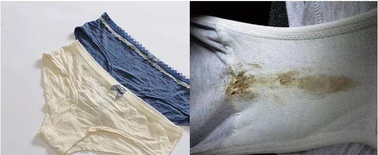难受,难看,尴尬世界卫生组织就多次警告:女性80%的妇科病都与内裤有关