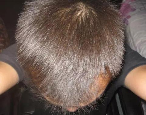 好头发: 脂溢性脱发,官方名称叫"雄激素性秃发",英文名很长,缩写叫"