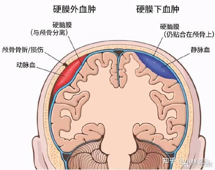 硬膜下血肿卡通图片