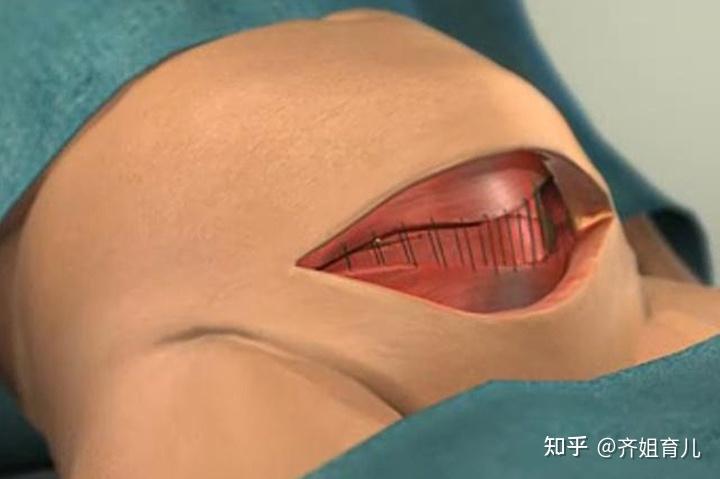 宝妈吐槽分娩时的尴尬头胎顺产被剃毛二胎剖腹产也没逃掉