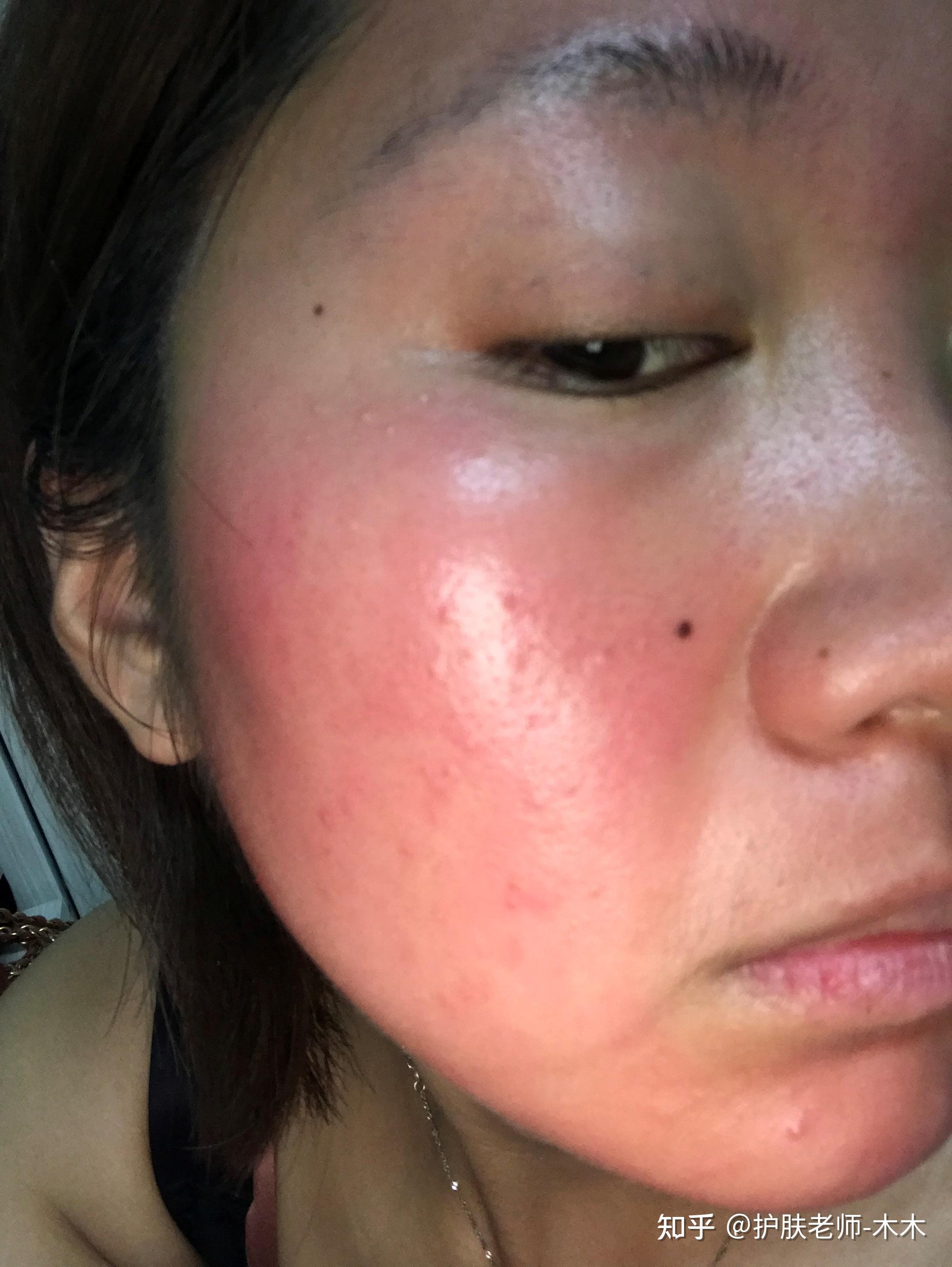 过敏反复,脸颊泛红,皮肤瘙痒长疹子?小心!可能是激素脸