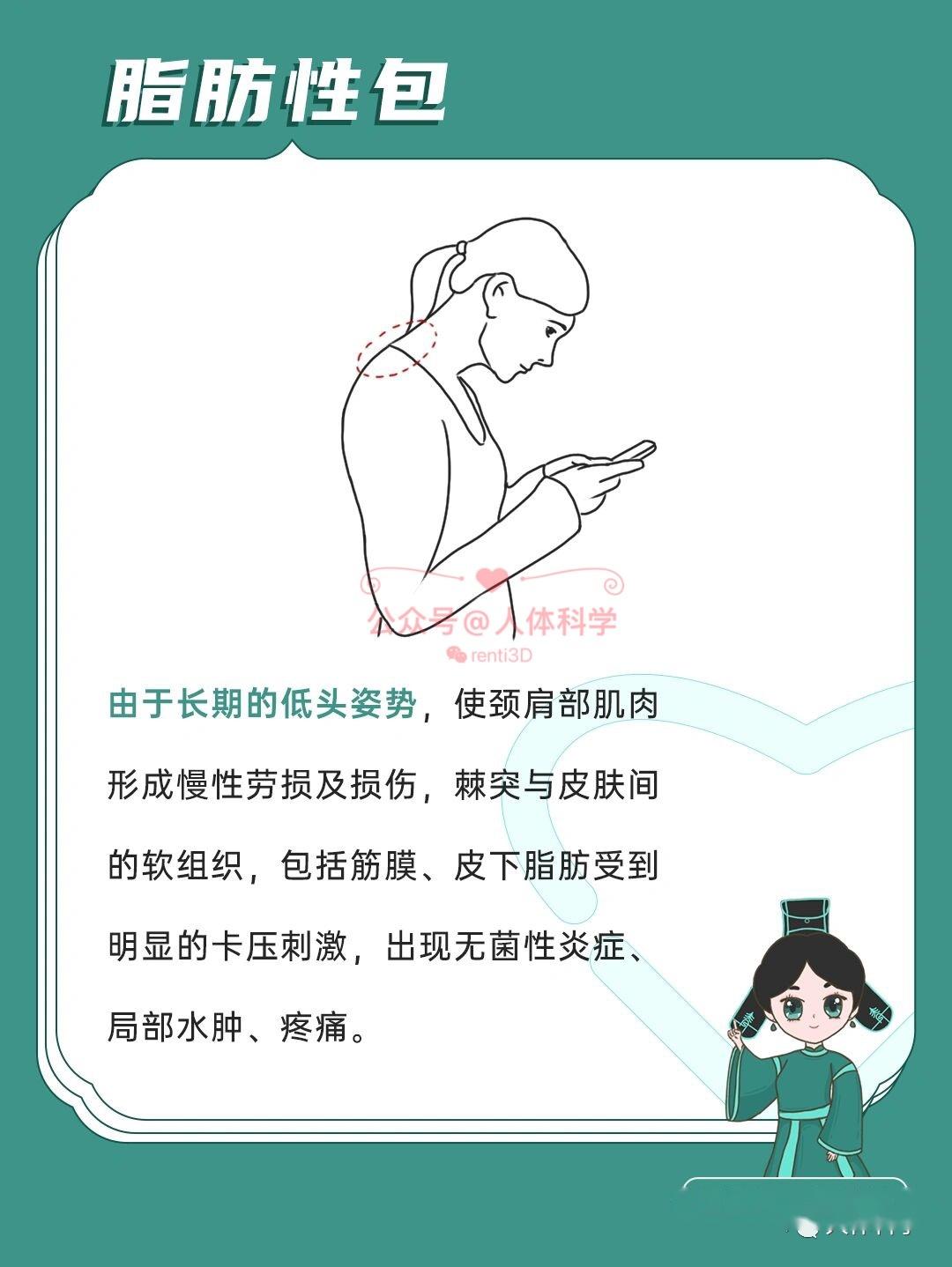 14什么是富贵包14"富贵包"指的是在后背上部颈