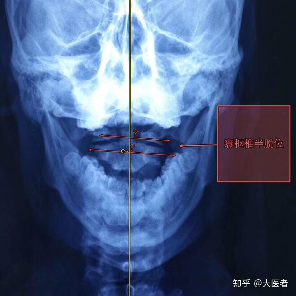 颈椎侧弯有哪些适合的恢复运动