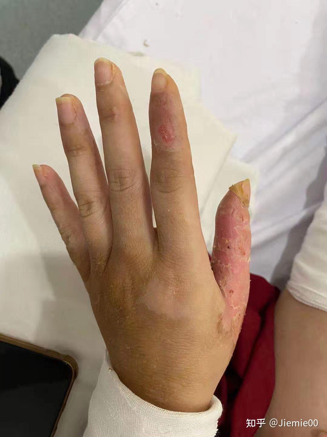火锅烫伤深2度浅2度恢复后寻求抗瘢痕治疗方法