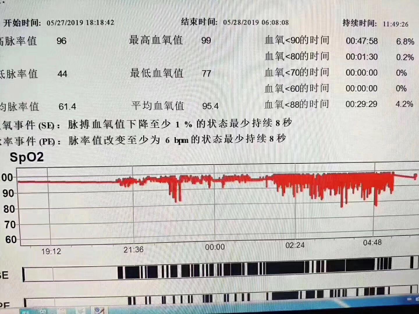 多导睡眠图psg 预防打鼾要提早 知乎 多导睡眠图psg 预防打鼾要提早 知乎