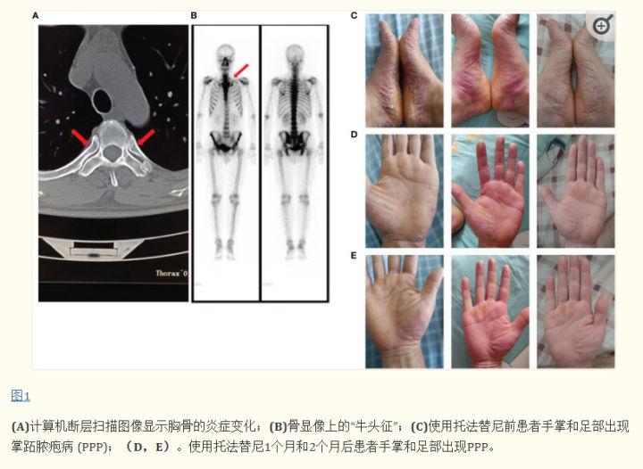 托法替尼成功治疗强直性脊柱炎并发SAPHO综合征的一例报告! - 知乎