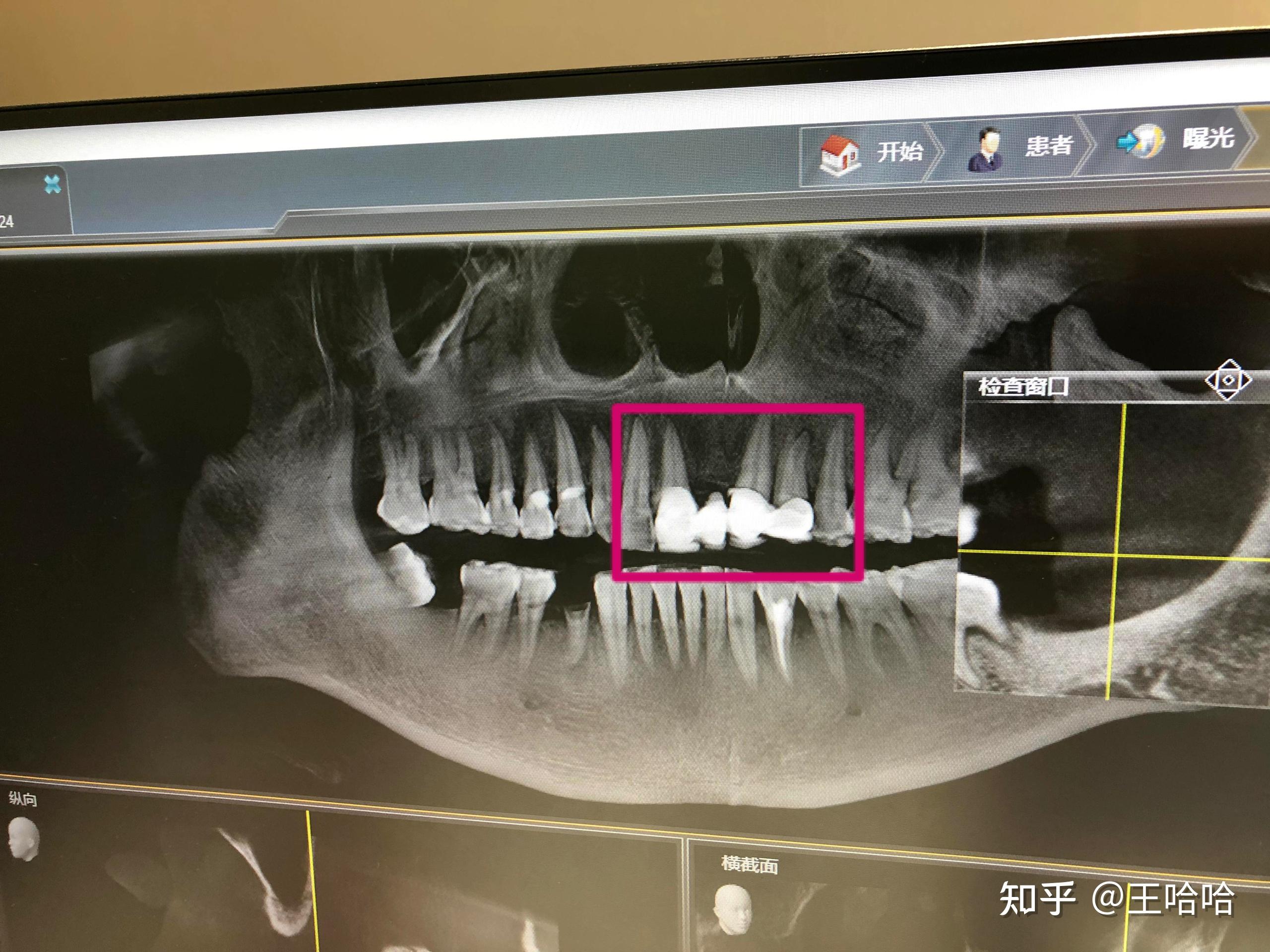 多颗牙缺失＋龋齿＋牙周病 - 知乎