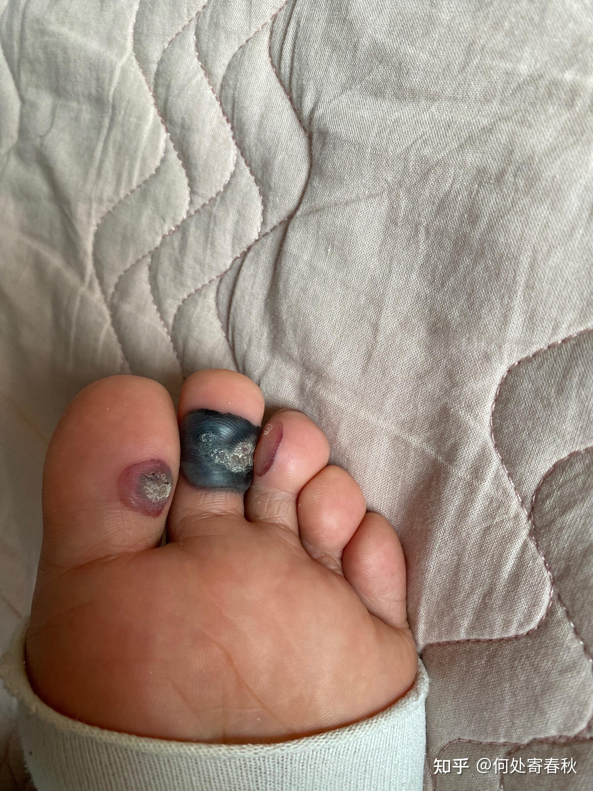 继续第五天 不怎么疼了 就是还没下去紫血泡第四天不知道要不要处理一