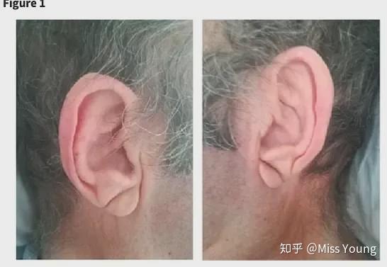 耳朵有褶皱表示有心脏疾病吗?