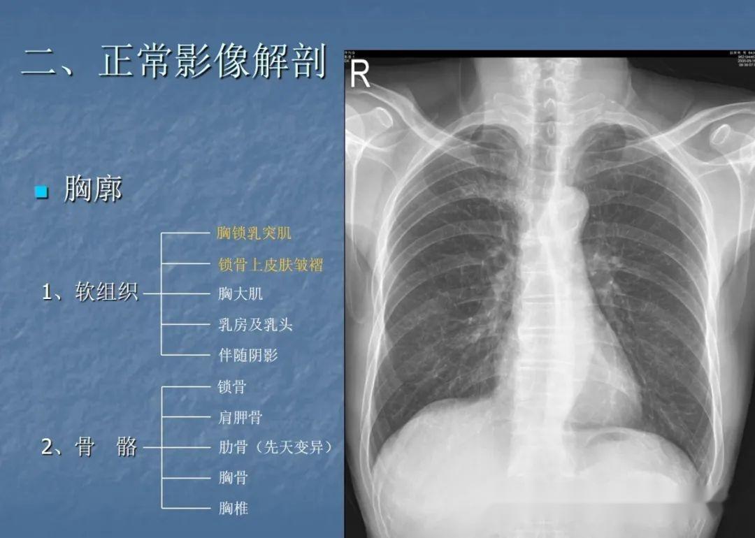 胸部CT读片技巧汇总 - 知乎