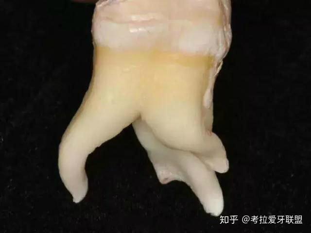 如果牙根长的这么有个性,那盲目拔牙吃苦头的可就是你了! - 知乎