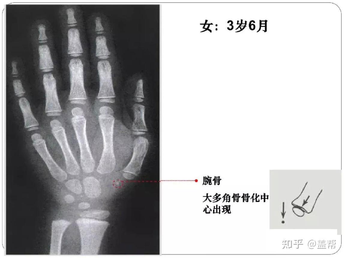 骨龄几岁还能长高吗女孩篇