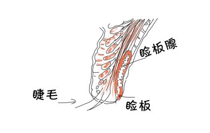 的就是自身分泌出来的泪液,还有一个重要的帮助保湿的结构就是:睑板腺