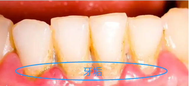 牙结石和牙垢的区别图片