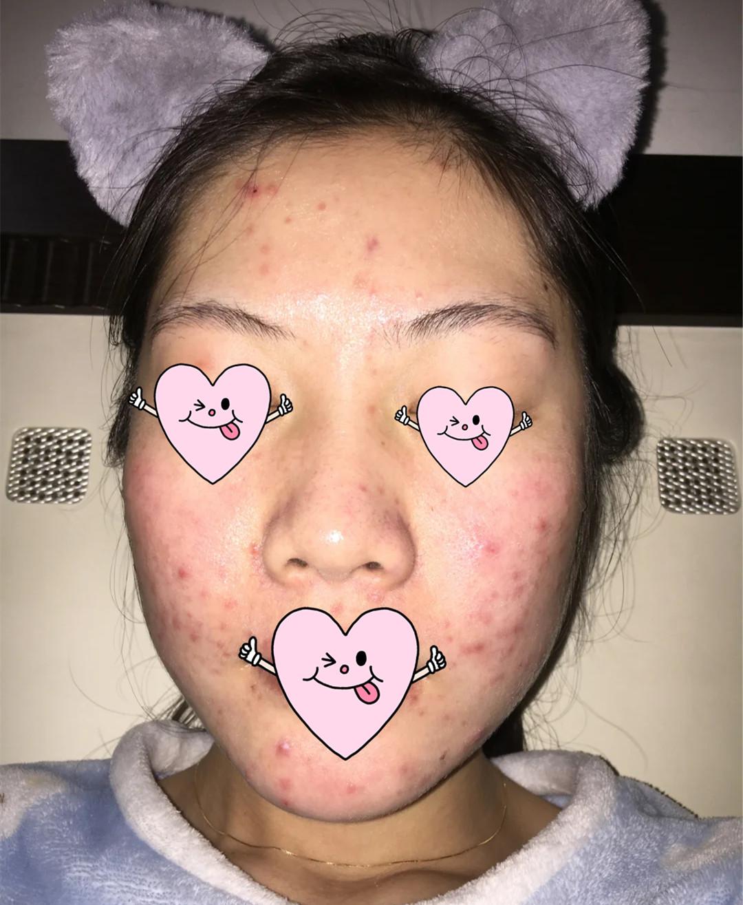 刷酸真的有用嘛 v2-3c766c4c925d0294d226d736543f5260_1440w.jpg?source=172ae18b