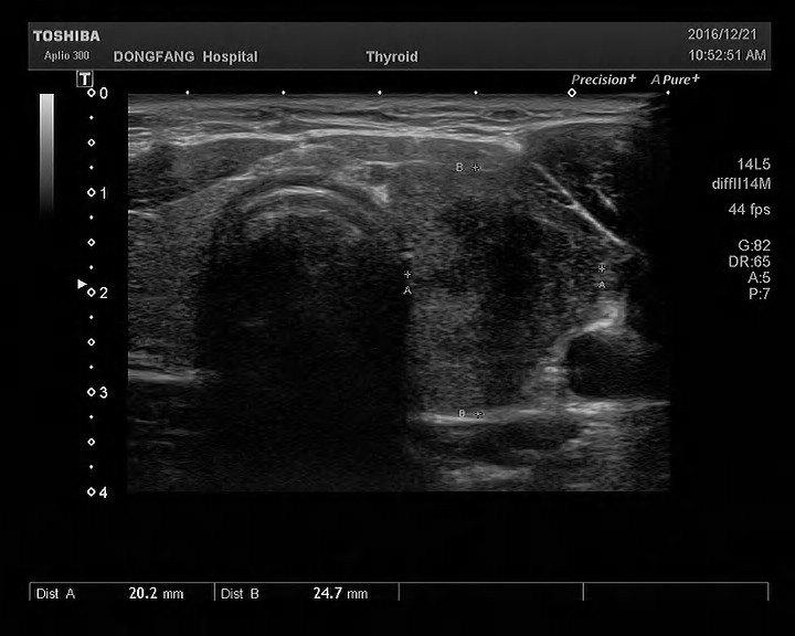 上图便是一位亚急性甲状腺炎患者,超声提示病变位于甲状腺左侧叶.