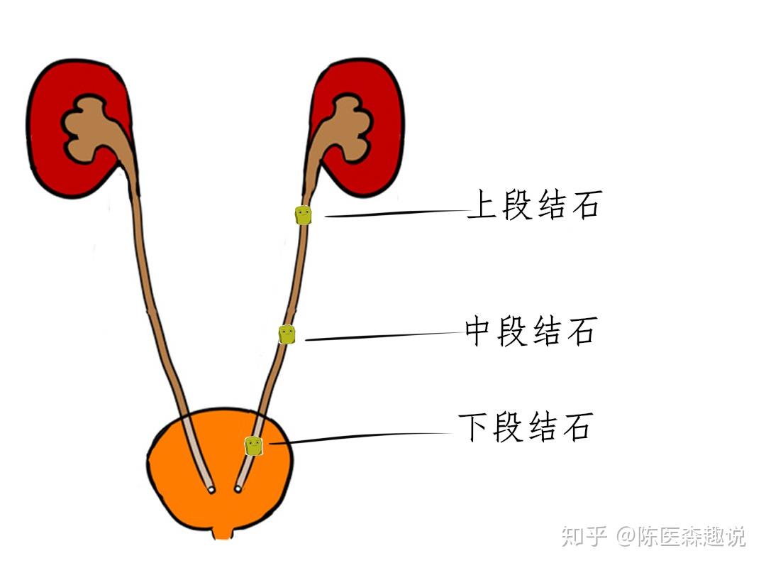 输尿管膀胱吻合术-泌尿外科手术-医学