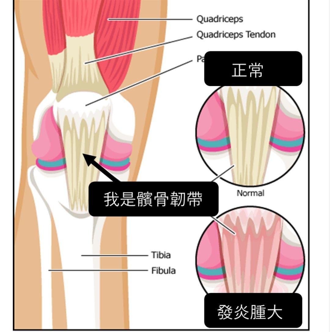 髕腱炎可以治好嗎 十九短知乎