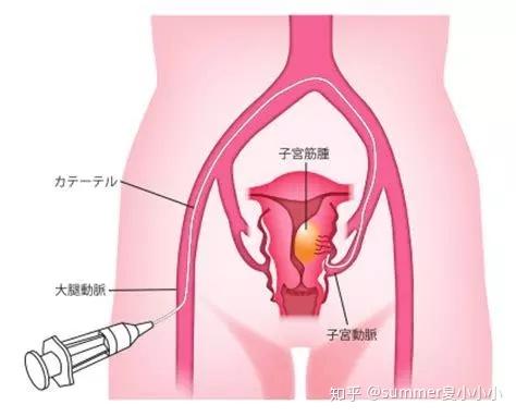 科普 子宫肌瘤的检查和诊治方式 知乎
