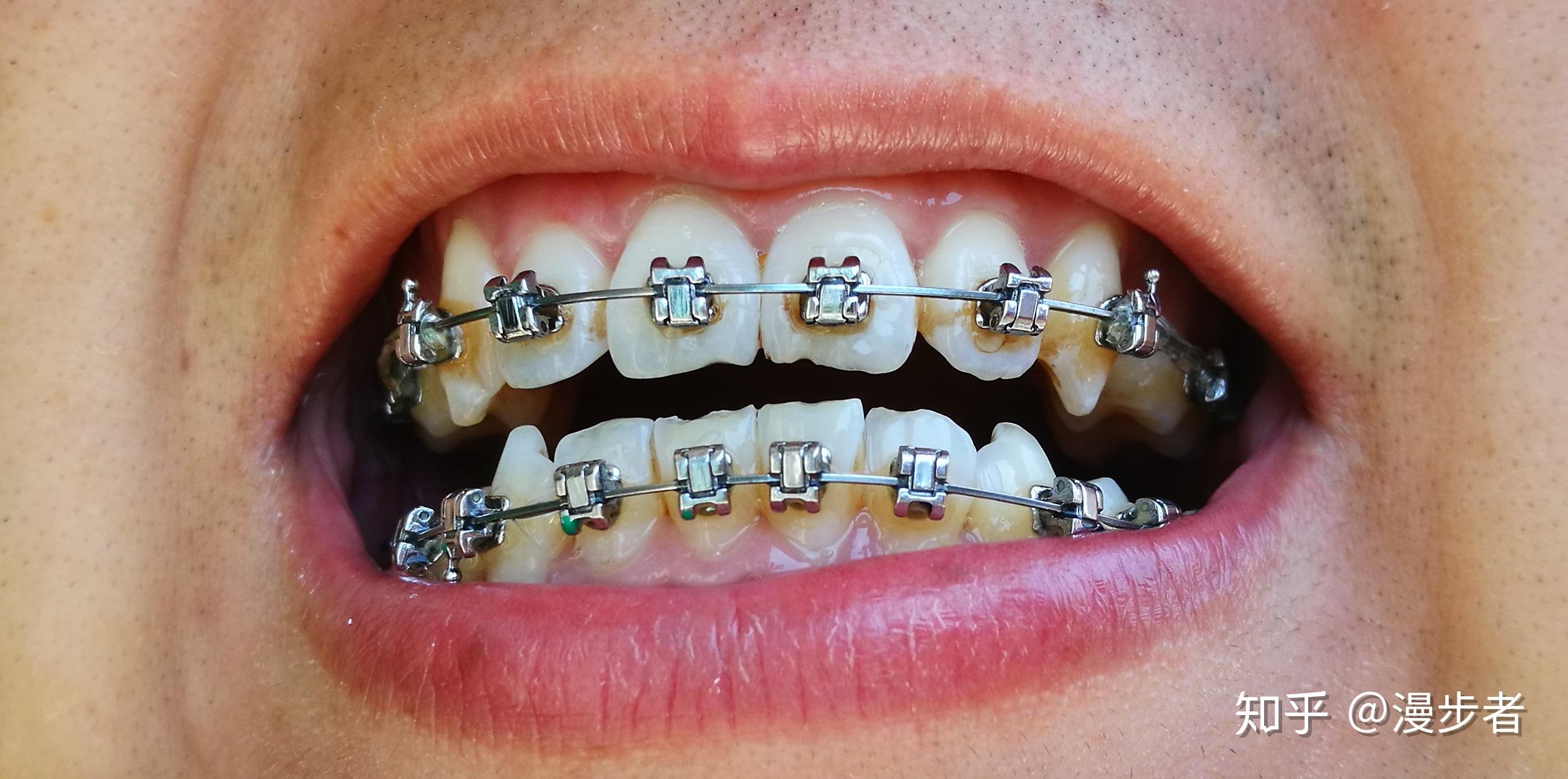 正畸用的进口的自锁托槽和国产的自锁托槽有什么区别?