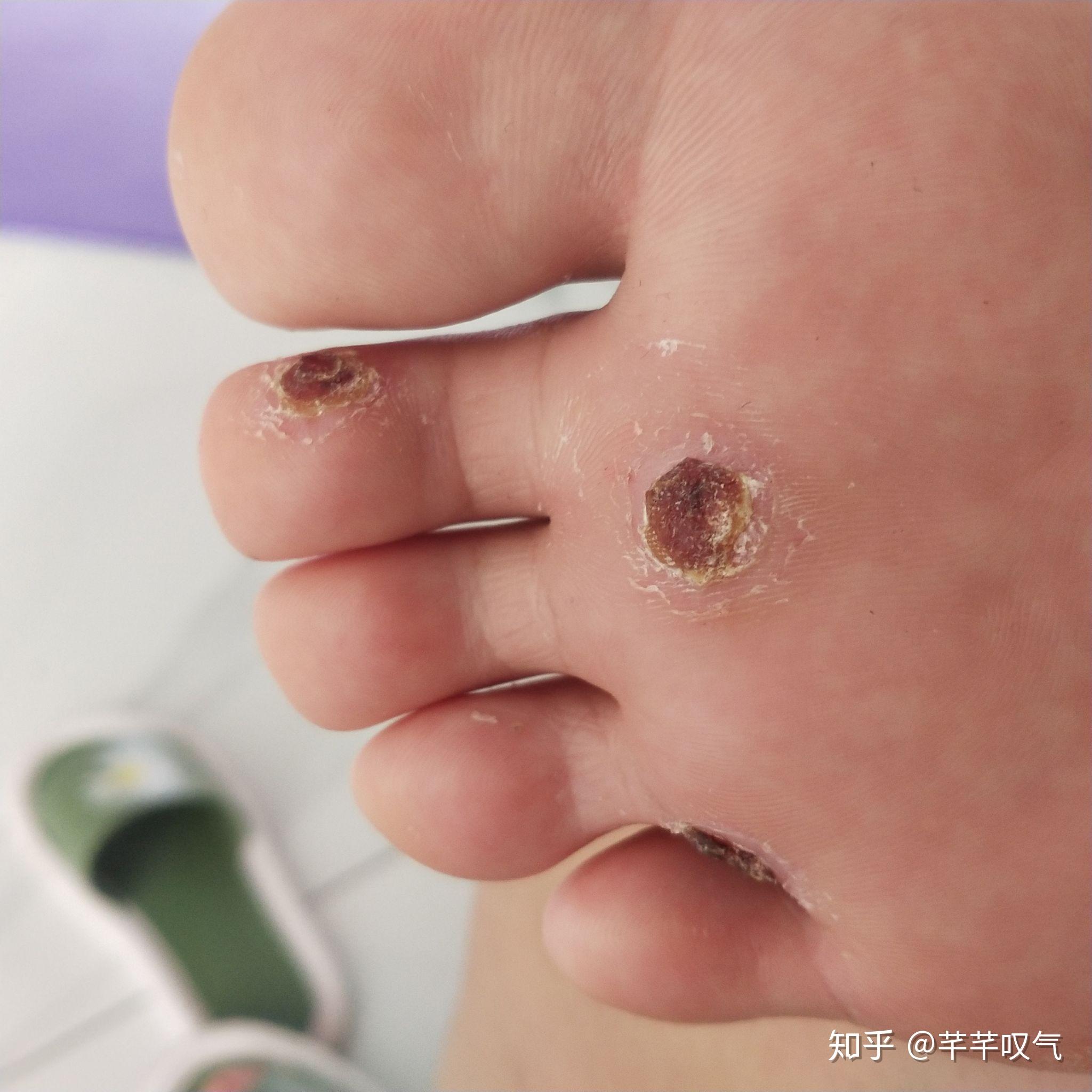 鸦胆子跖疣 - 知乎